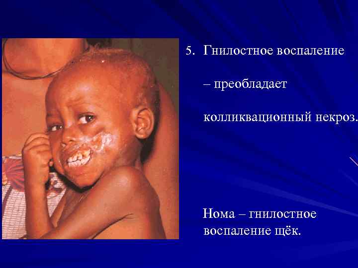 5. Гнилостное воспаление – преобладает колликвационный некроз. Нома – гнилостное воспаление щёк. 
