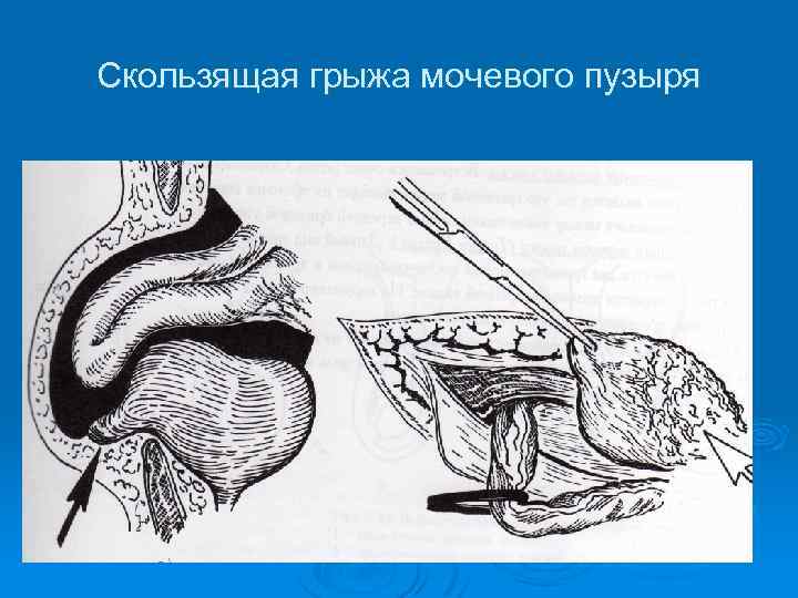 Скользящая грыжа. Скользящая паховая грыжа мочевого пузыря. Скользящие грыжи мочевого пузыря. Грыжа пузыря мочевого пузыря. Скользящая грыжа передней брюшной стенки.