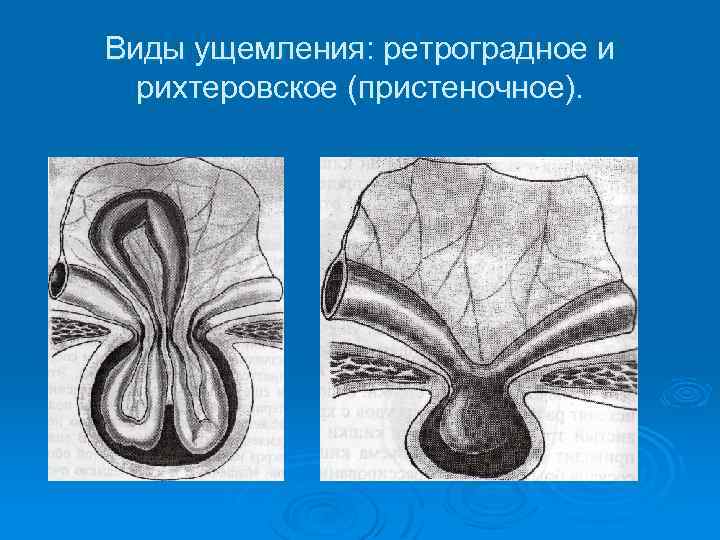 Какова клиническая картина при рихтеровском ущемлении