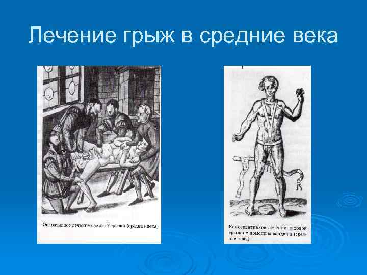 Лечение грыж в средние века 