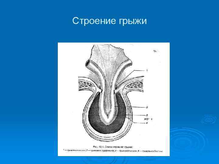 Ущемленная грыжа передней брюшной стенки. Анатомическое строение грыжи. Строение грыжевого мешка.