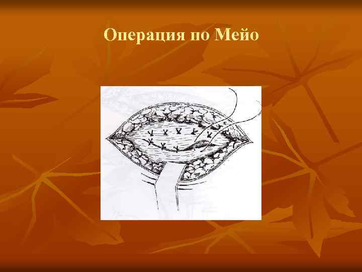 Операция по Мейо 