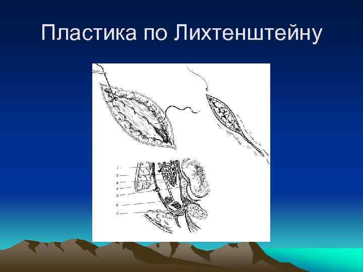 Пластика по Лихтенштейну 