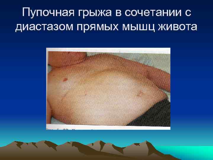 Пупочная грыжа в сочетании с диастазом прямых мышц живота 