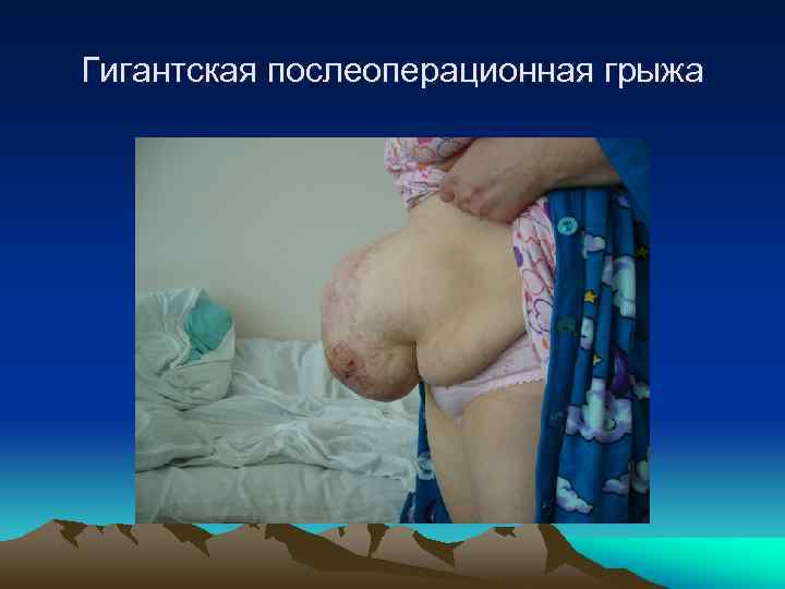 Гигантская послеоперационная грыжа 