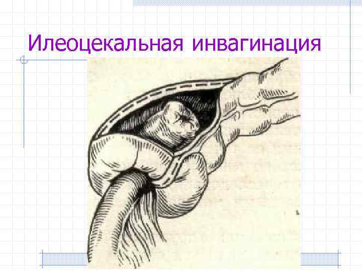 Инвагинация кишечника. Илеоцекальная инвагинация кишечника. Слепо ободочная инвагинация. Илеоцекальная инвагинация кишечника у детей. Илеоцекальная кишечная непроходимость.