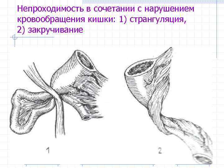 Кишечная непроходимость карта вызова шпаргалки