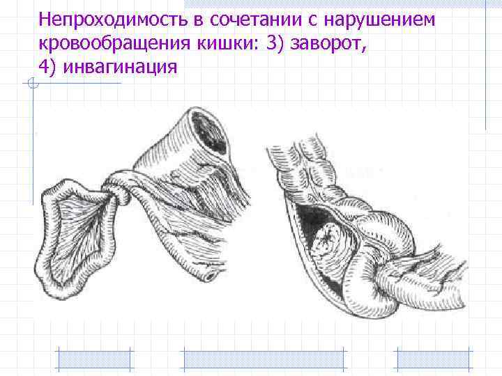 О кишечная непроходимость карта вызова