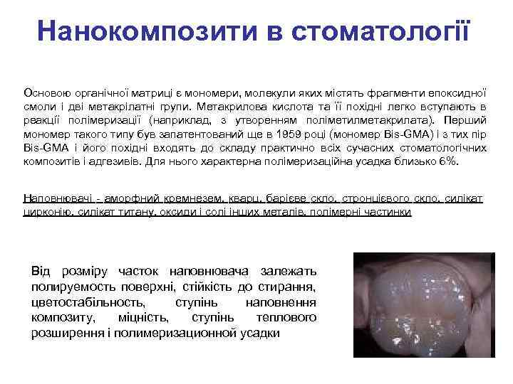 Нанокомпозити в стоматології Основою органічної матриці є мономери, молекули яких містять фрагменти епоксидної смоли