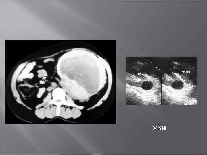 УЗИ 