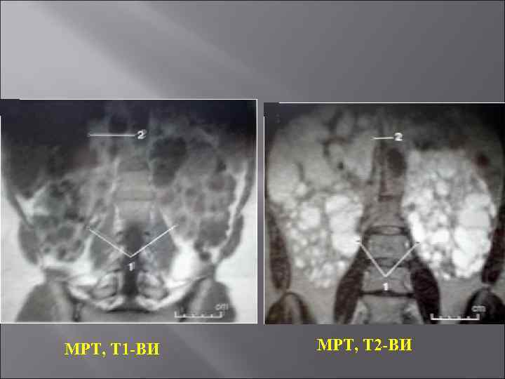 МРТ, Т 1 -ВИ МРТ, Т 2 -ВИ 