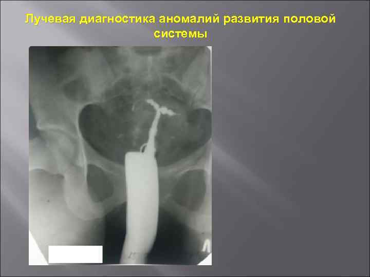 Лучевая диагностика аномалий развития половой системы 