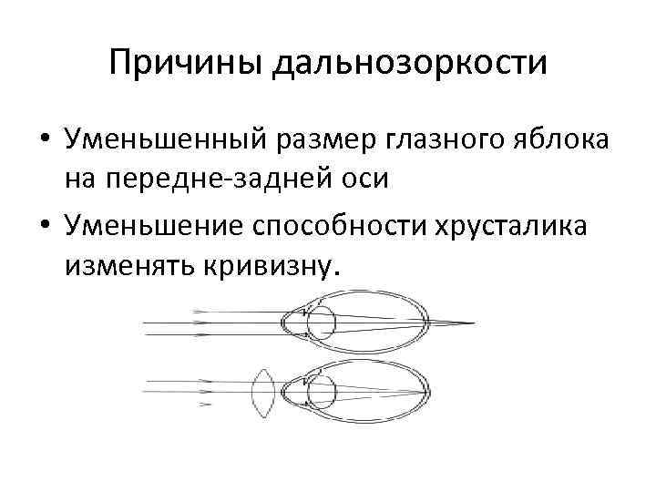 Каковы причины дальнозоркости. Дальнозоркость причины возникновения кратко. Симптомы заболевания дальнозоркостью. Причины заболевания дальнозоркости. Дальнозоркость причины профилактика.