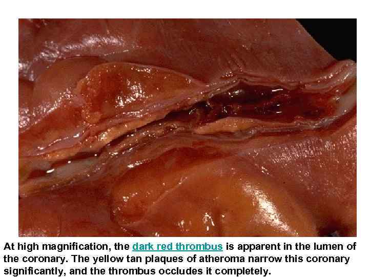 At high magnification, the dark red thrombus is apparent in the lumen of the