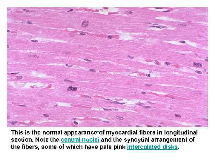  This is the normal appearance of myocardial fibers in longitudinal section. Note the