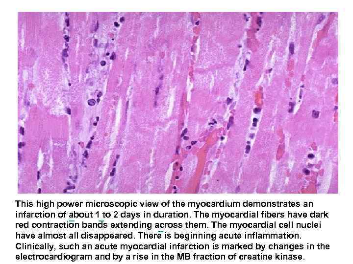 This high power microscopic view of the myocardium demonstrates an infarction of about 1