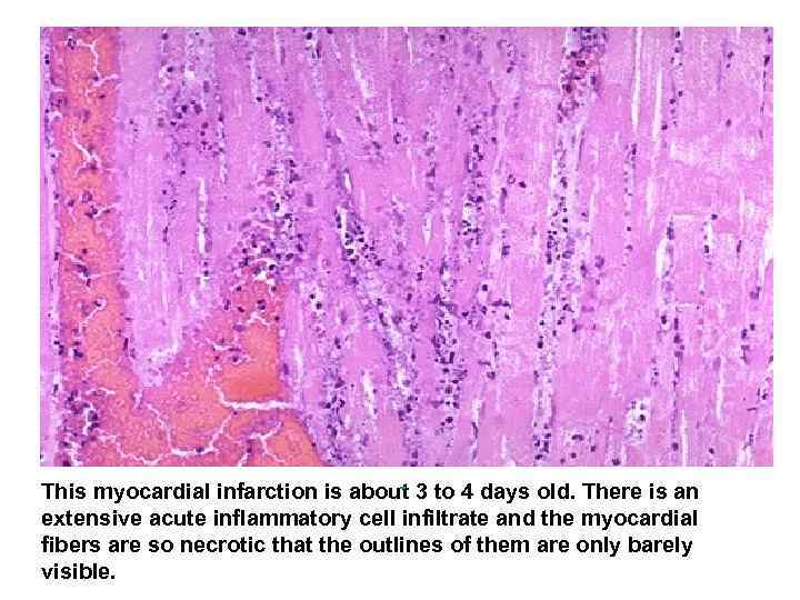  This myocardial infarction is about 3 to 4 days old. There is an