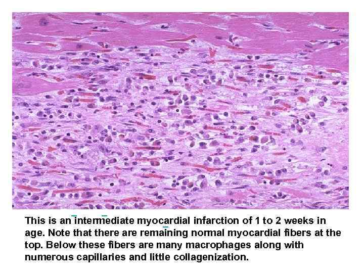  This is an intermediate myocardial infarction of 1 to 2 weeks in age.