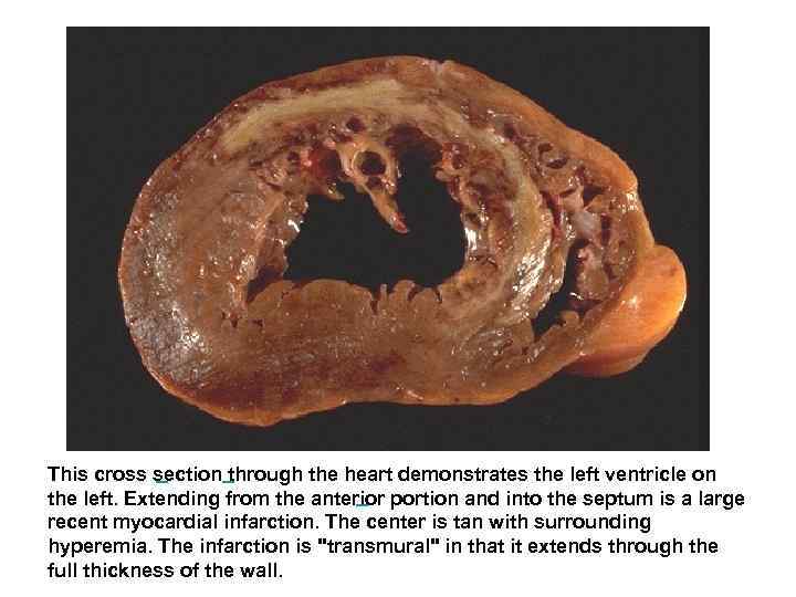  This cross section through the heart demonstrates the left ventricle on the left.