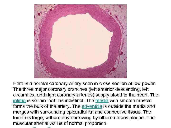 Here is a normal coronary artery seen in cross section at low power. The