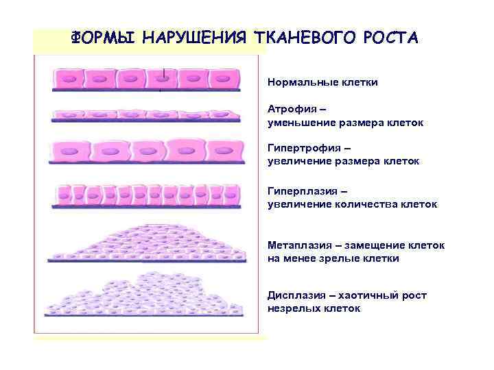 ФОРМЫ НАРУШЕНИЯ ТКАНЕВОГО РОСТА Нормальные клетки Атрофия – уменьшение размера клеток Гипертрофия – увеличение