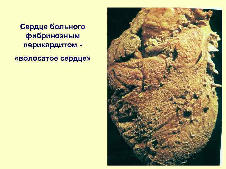 Сердце больного фибринозным перикардитом «волосатое сердце» 