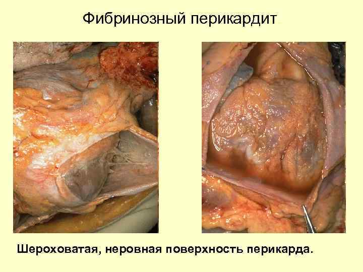 Фибринозный перикардит. Шероховатая, неровная поверхность перикарда. 