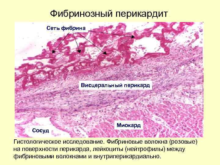 Фибринозный перикардит. Сеть фибрина Висцеральный перикард Сосуд Миокард Гистологическое исследование. Фибриновые волокна (розовые) на