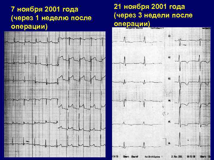 7 ноября 2001 года (через 1 неделю после операции) 21 ноября 2001 года (через