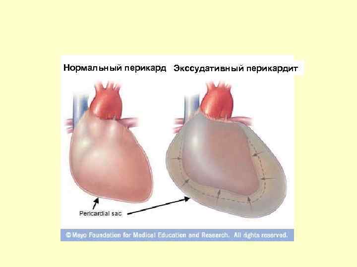 Нормальный перикард Экссудативный перикардит 