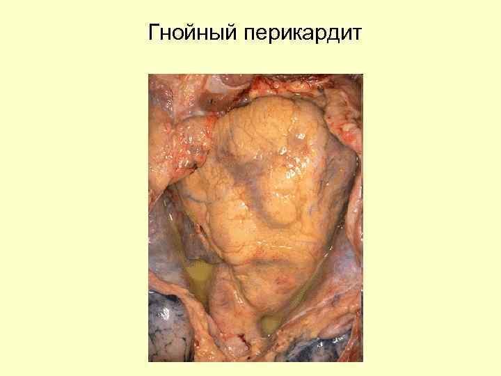 Гнойный перикардит 