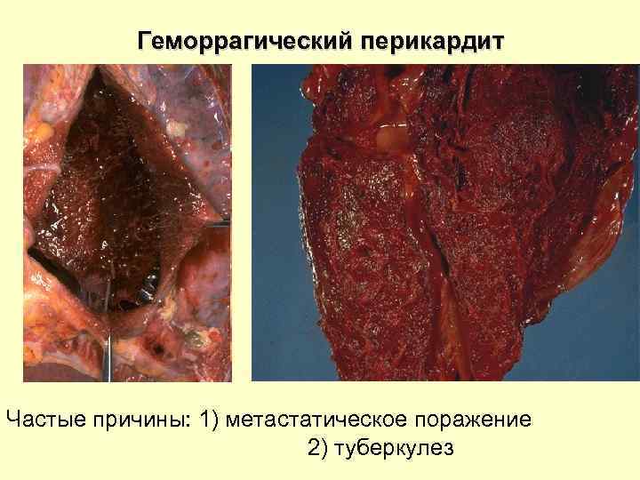 Геморрагический перикардит Частые причины: 1) метастатическое поражение 2) туберкулез 