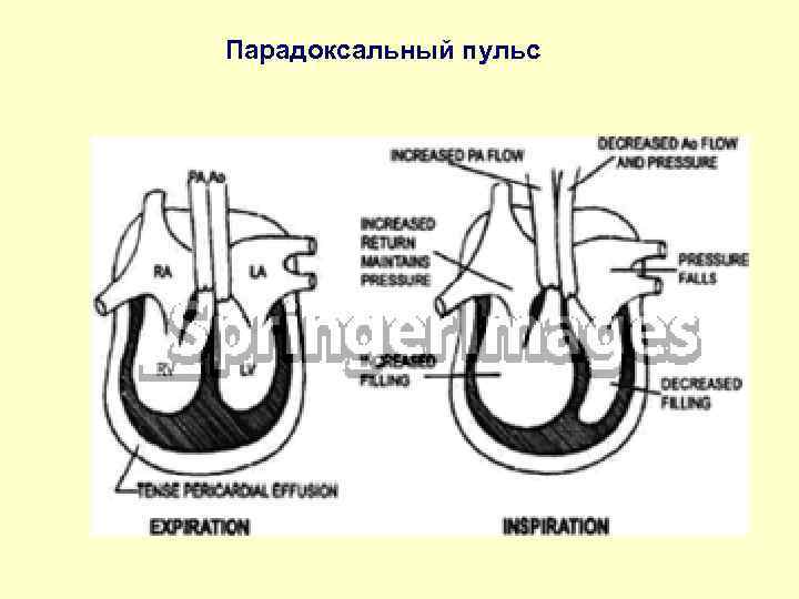 Парадоксальный пульс 