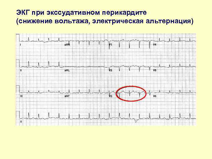 ЭКГ при экссудативном перикардите (снижение вольтажа, электрическая альтернация) 