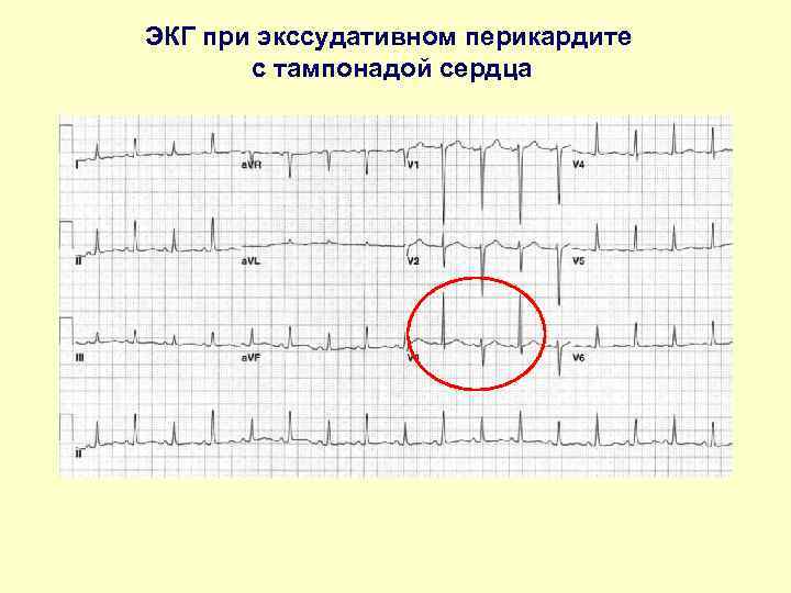 ЭКГ при экссудативном перикардите с тампонадой сердца 