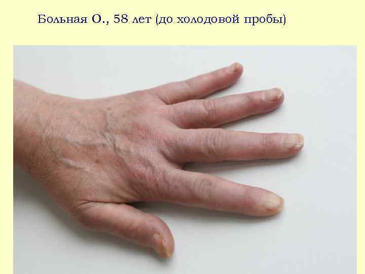 Больная О. , 58 лет (до холодовой пробы) 