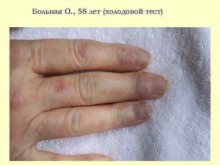 Больная О. , 58 лет (холодовой тест) 