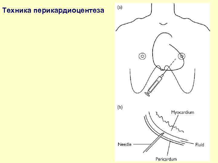 Техника перикардиоцентеза 