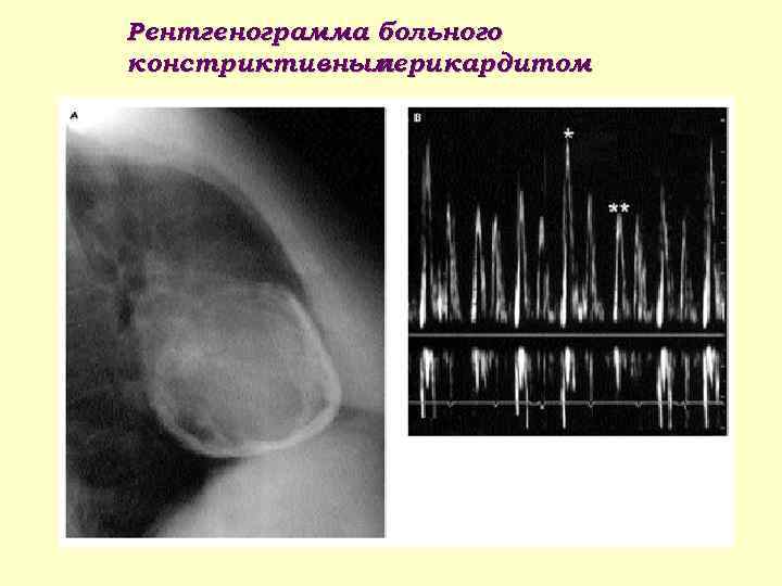 Рентгенограмма больного констриктивным перикардитом 
