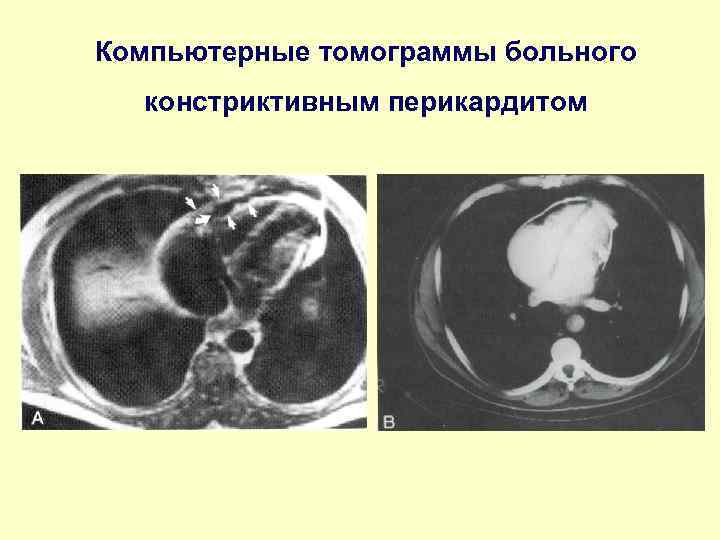 Компьютерные томограммы больного констриктивным перикардитом 