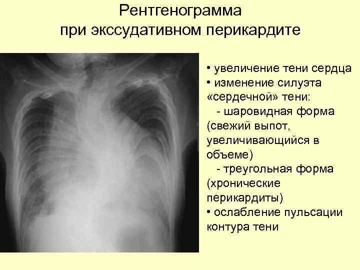 Pентгенограмма при экссудативном перикардите • увеличение тени сердца • изменение силуэта «сердечной» тени: -