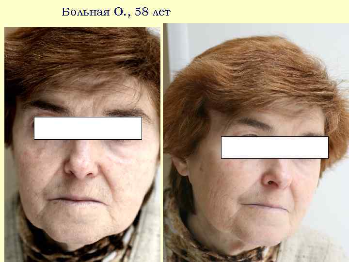 Больная О. , 58 лет 