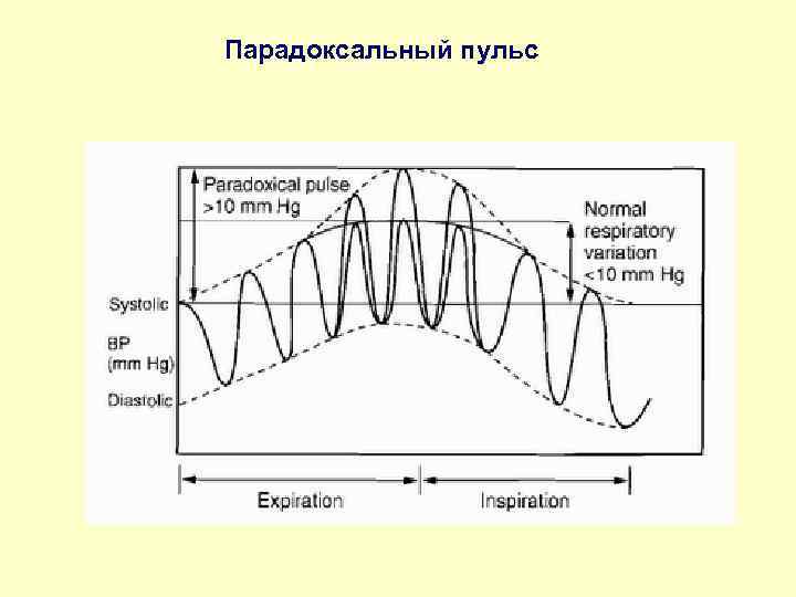 Парадоксальный пульс 