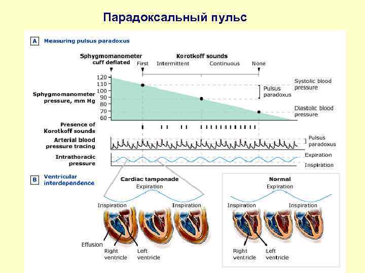 Парадоксальный пульс 