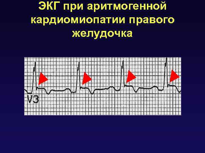 ЭКГ при аритмогенной кардиомиопатии правого желудочка 