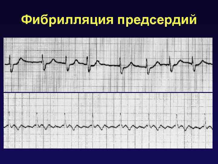 Фибрилляция предсердий 