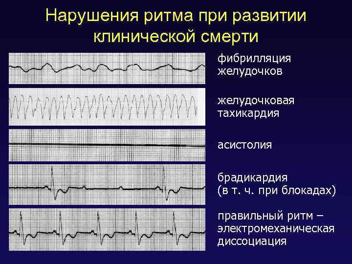 Нарушения ритма при развитии клинической смерти фибрилляция желудочковая тахикардия асистолия брадикардия (в т. ч.