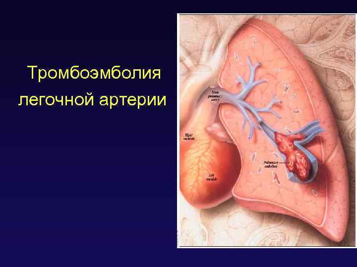 Тромбоэмболия легочной артерии 
