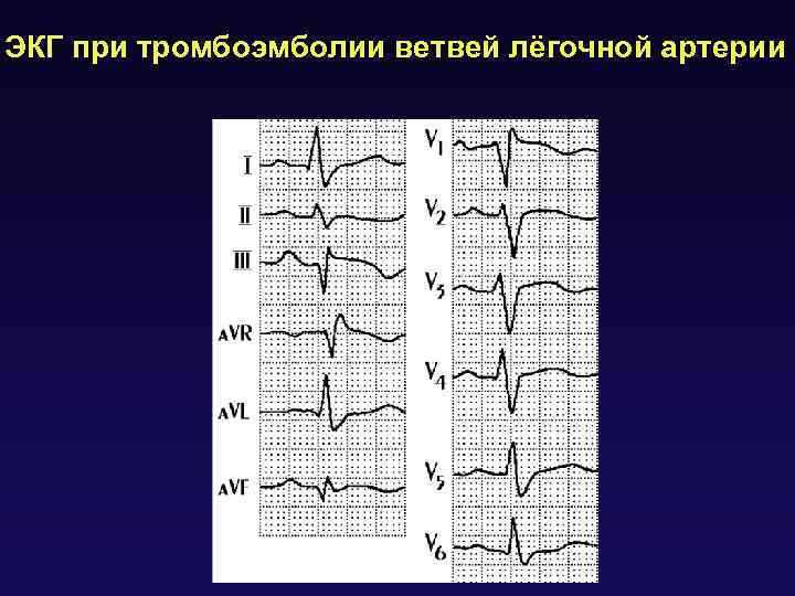 ЭКГ при тромбоэмболии ветвей лёгочной артерии 