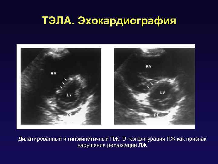 ТЭЛА. Эхокардиография Дилатированный и гипокинетичный ПЖ. D- конфигурация ЛЖ как признак нарушения релаксации ЛЖ